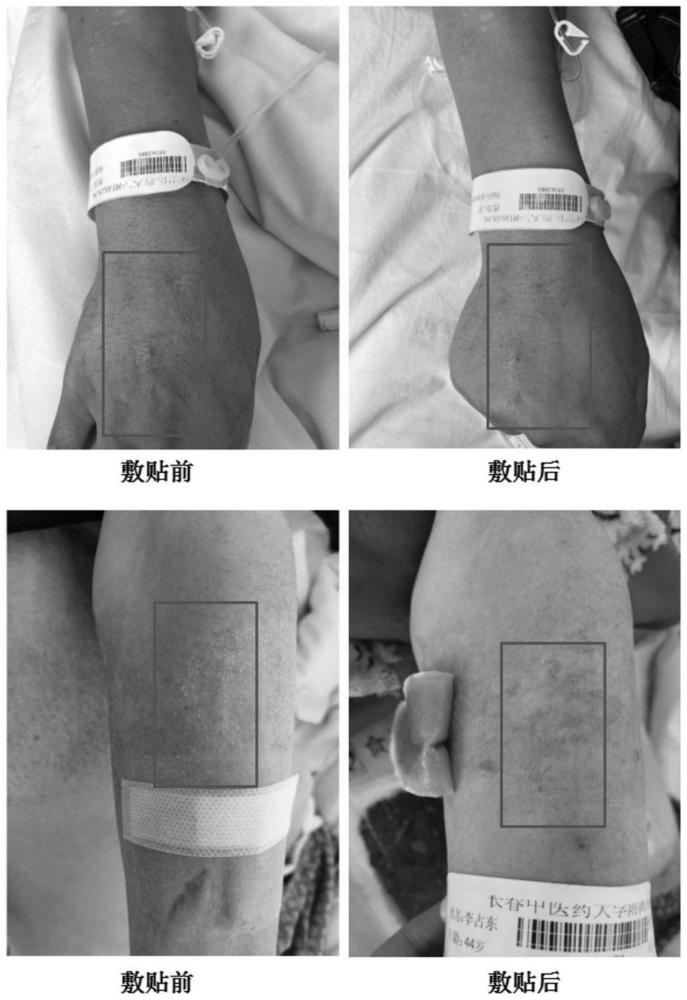 一種治療靜脈炎的中藥復方及其制備方法與應用